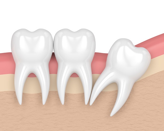 Illustration of wisdom tooth growing in sideways